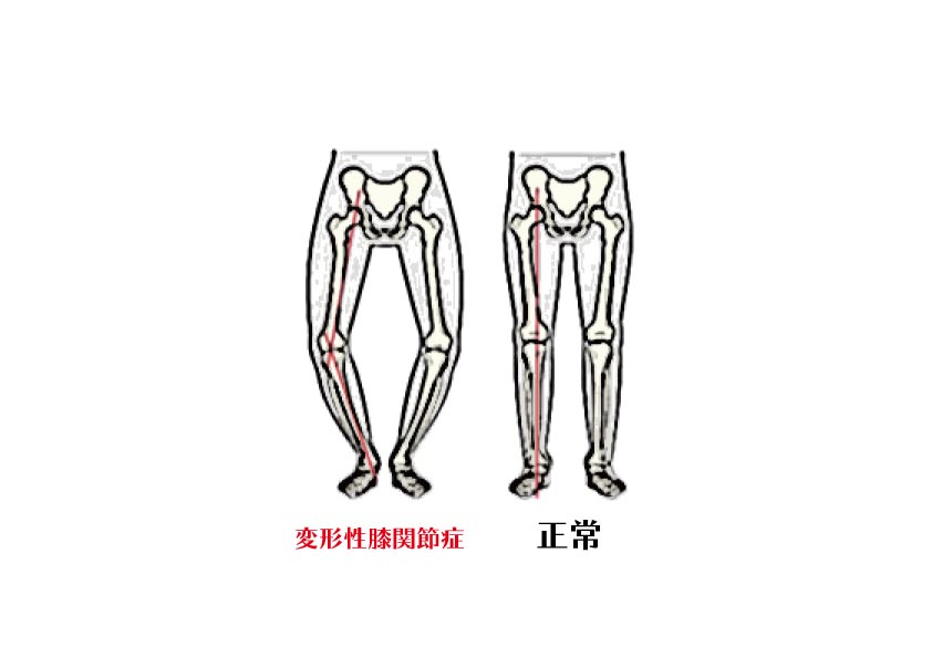 変形性膝関節症2
